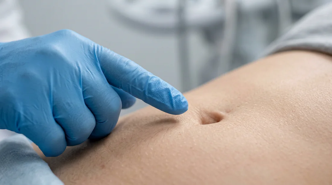 Illustration médicale montrant une zone abdominale